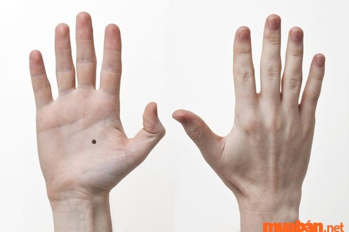 Nốt ruồi trên bàn tay