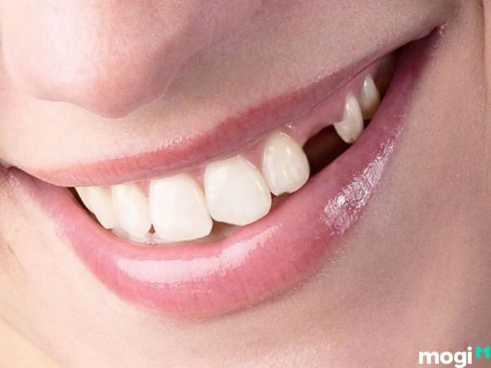 Giấc Mơ Rụng Răng Hàm Trên: Điềm Báo Gì Về Cuộc Sống Và Sức Khỏe?