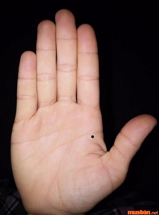 Nốt ruồi ở bàn tay