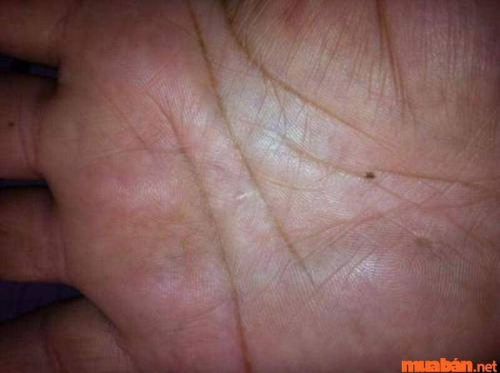 Nốt ruồi trên bàn tay nam