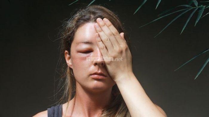 Mơ thấy mình khóc và mắt sưng lên