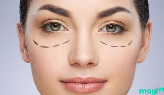 Phẫu thuật thẩm mỹ để khắc phục mắt 1 mí được thực hiện qua 5 bước đơn giản và hiệu quả.