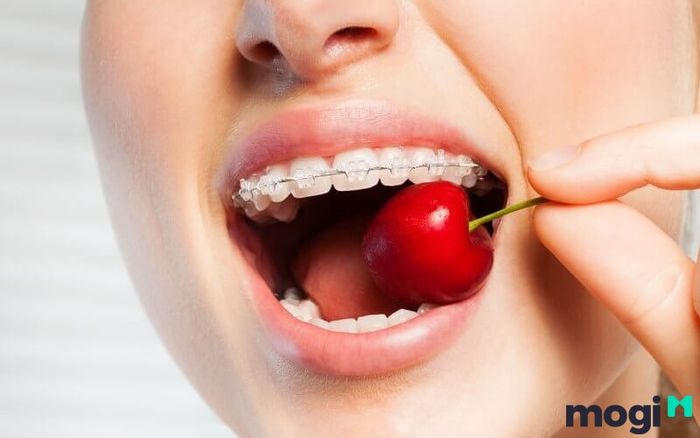 Khi niềng răng, bạn nên hạn chế tiêu thụ các món ăn cứng