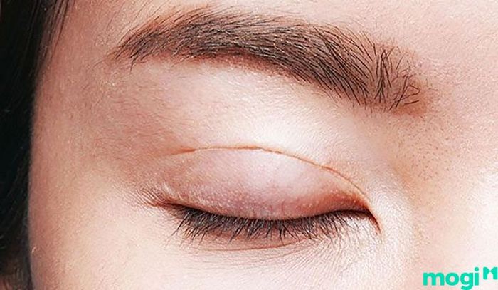 Cắt mí là một phương pháp hiệu quả giúp khắc phục mắt 1 mí, mang lại đôi mắt to tròn và cuốn hút hơn.
