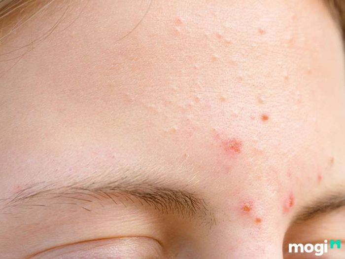 Lông trắng mọc trên mặt