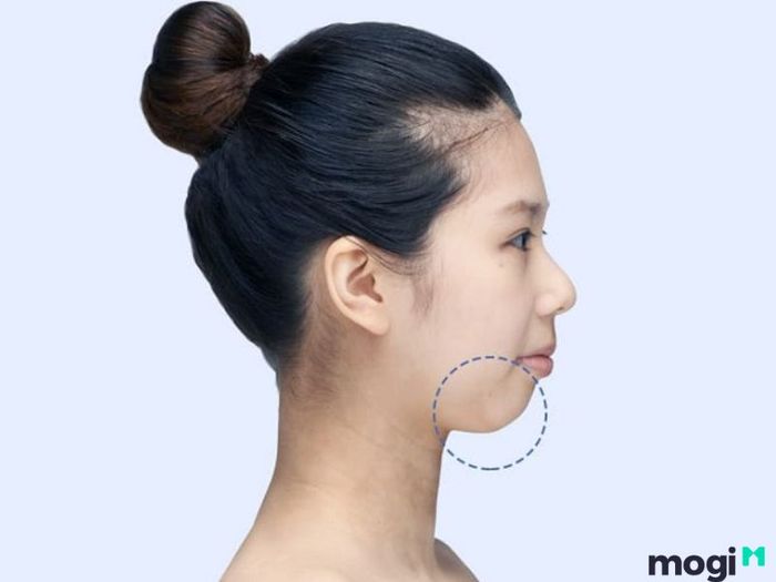 Cằm lẹm do sai lệch khớp cắn