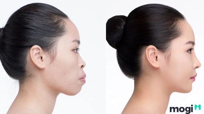 Nhận diện và dấu hiệu của cằm lẹm