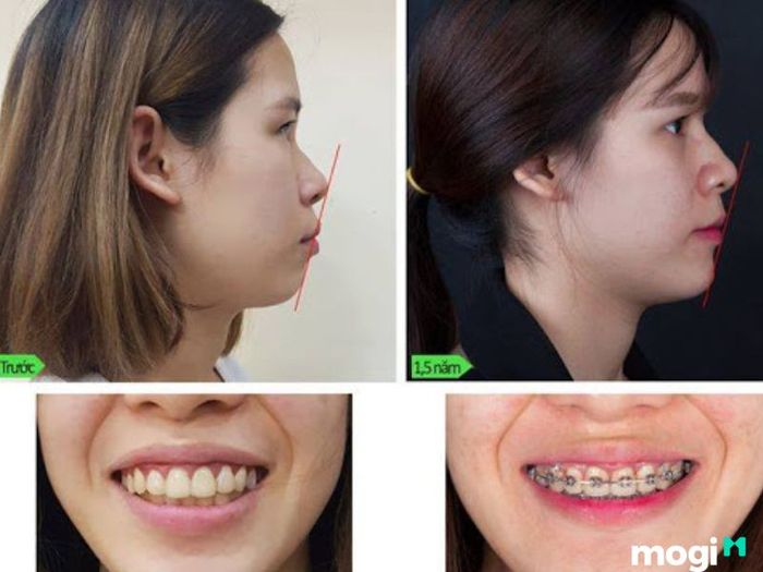 Niềng răng chỉnh cằm lẹm