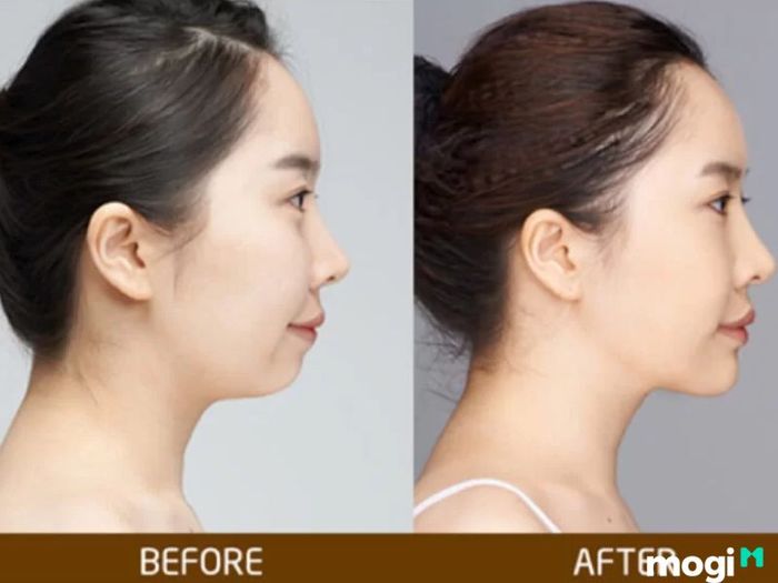Cằm lẹm ảnh hưởng đến công danh và sự nghiệp của nữ giới như thế nào?