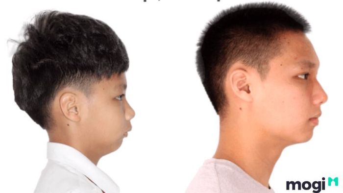 Đường tình duyên của nam giới có cằm lẹm