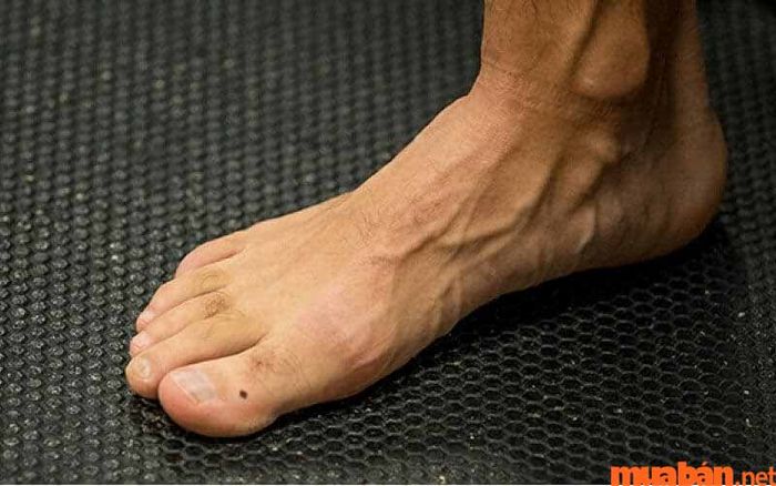 nốt ruồi ở ngón chân cái