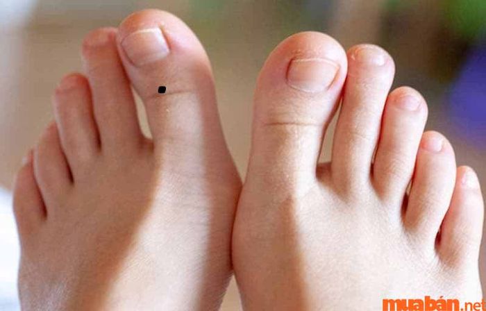 nốt ruồi trên ngón chân cái