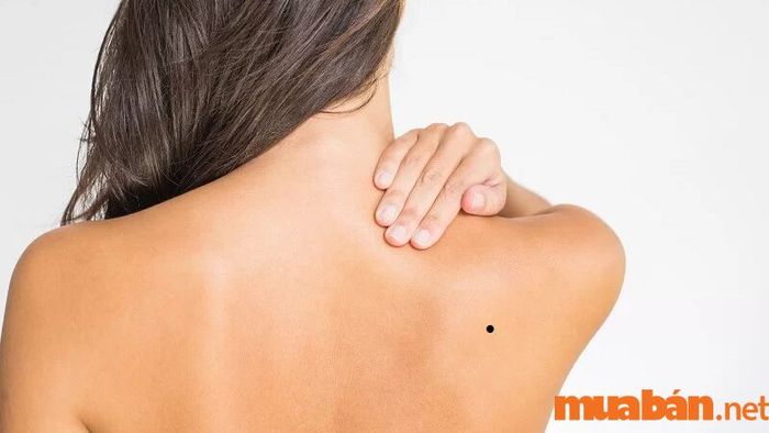 Nốt ruồi ở mép nách gần lưng