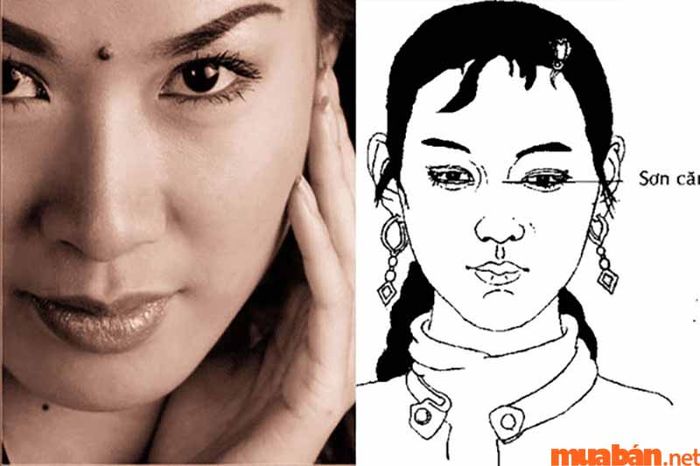 nốt ruồi tại sơn căn