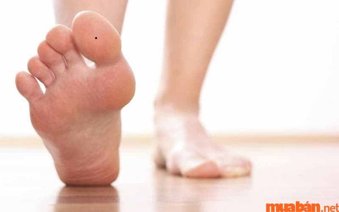 nốt ruồi ở ngón chân cái