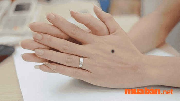 nốt ruồi ở cổ tay