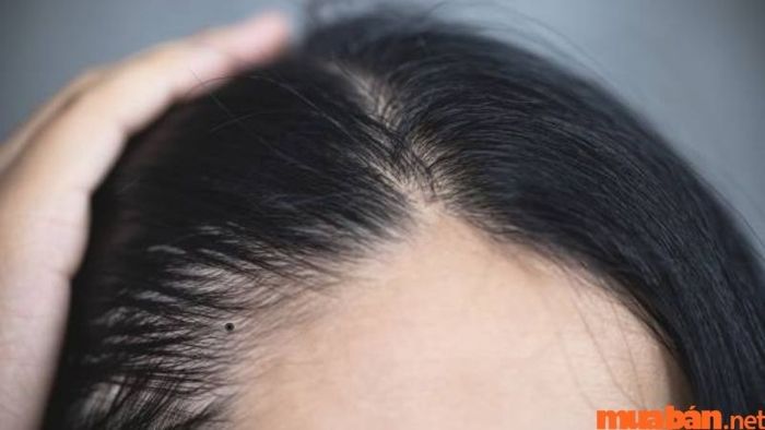 Nốt ruồi ở vị trí trong tóc