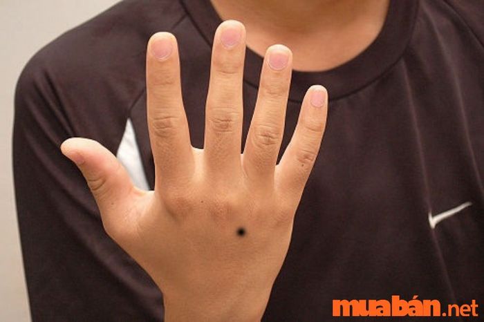 nốt ruồi trên mu bàn tay