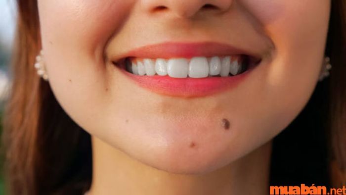 Nốt ruồi ở cằm trái