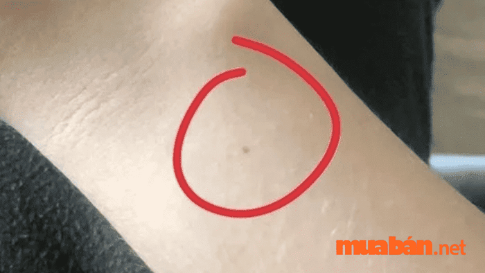 nốt ruồi ở cổ tay