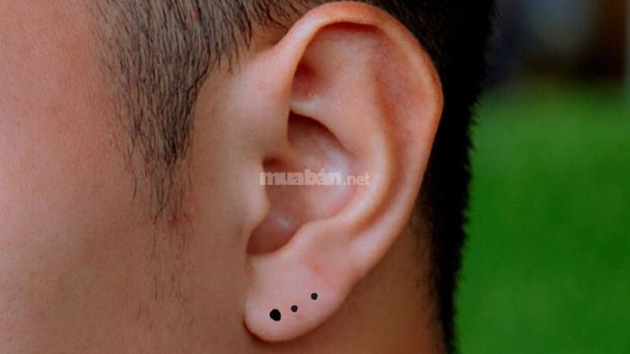 Nốt Ruồi Trên Dái Tai