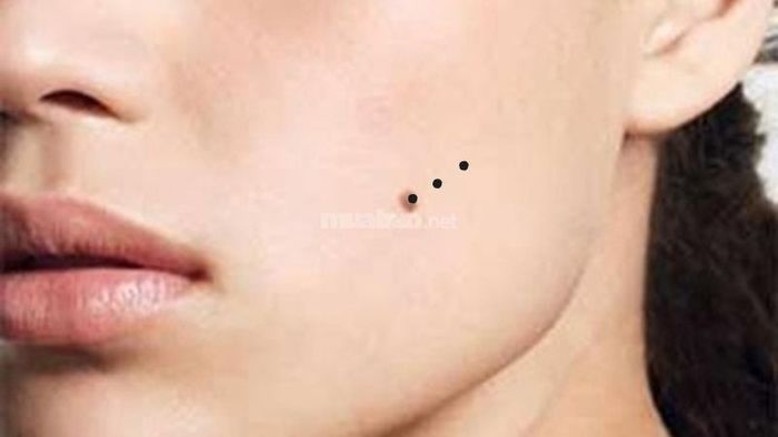 Nốt Ruồi Trên Má