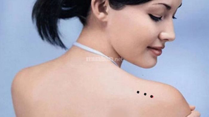 Nốt Ruồi Trên Vai