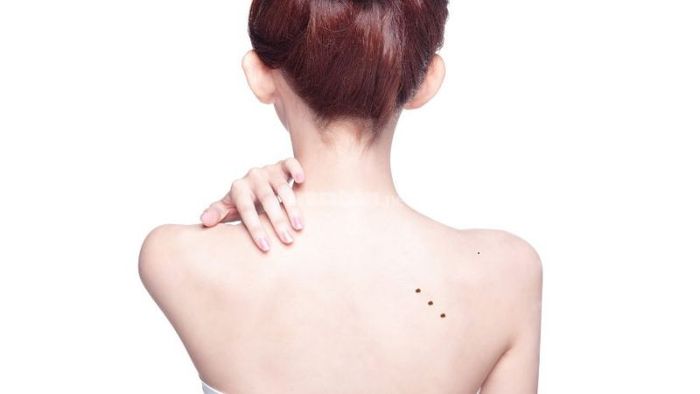 Nốt Ruồi Trên Lưng