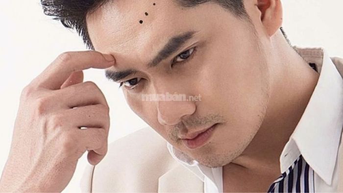 Nốt Ruồi Trên Trán