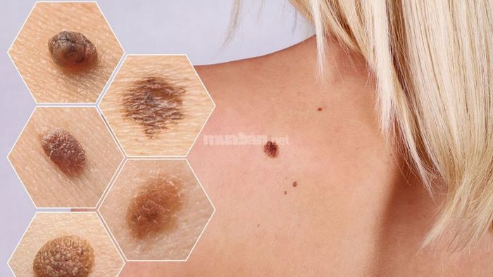 Các dấu hiệu nhận biết nốt ruồi cảnh báo bệnh nguy hiểm là gì?
