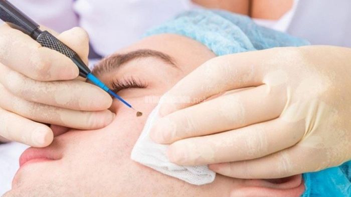 Liệu có nên xóa nốt ruồi lệ hay không?