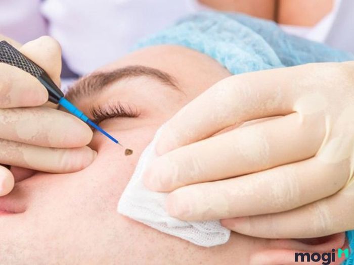 Có nên xóa nốt ruồi dưới cằm?