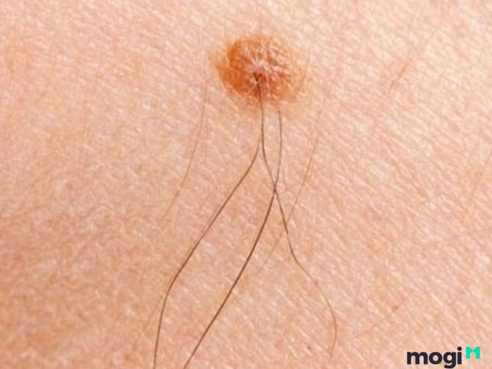 Nốt ruồi dưới cằm có lông ở nam giới