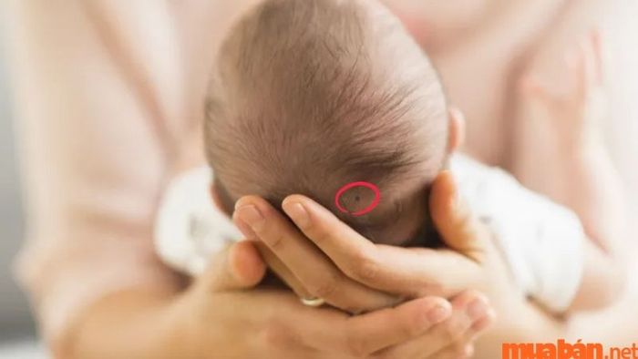 Nốt ruồi ở xoáy đỉnh đầu mang ý nghĩa gì?