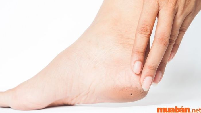 Ý nghĩa nốt ruồi ở gót chân của nam giới