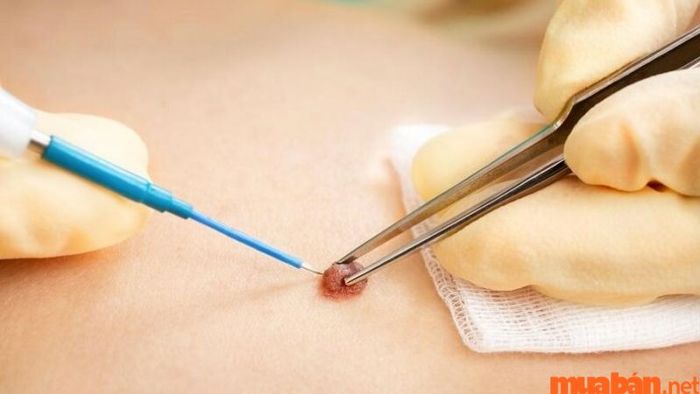 Xoá nốt ruồi ảnh hưởng đến nhân tướng học như thế nào?