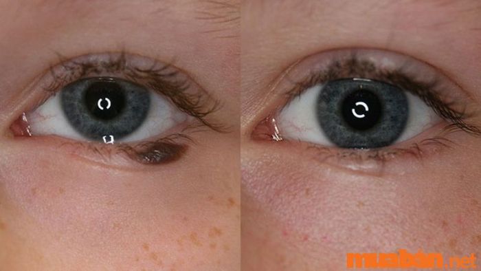 Liệu có nên tẩy nốt ruồi ở mắt?