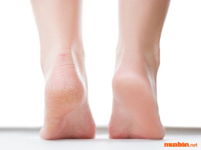 Gót chân hồng là dấu hiệu của người có tinh thần lạc quan, luôn tích cực đối mặt với mọi thử thách trong cuộc sống