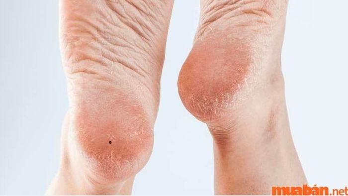 Nam giới có nốt ruồi ở gót chân trái thường rất kỹ lưỡng trong việc chọn lựa bạn đời của mình.