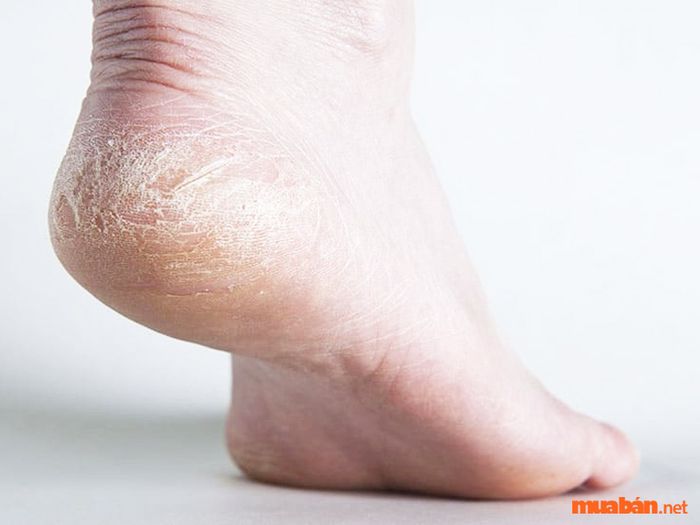 Gót chân nứt nẻ là biểu hiện của người có tình duyên không thuận lợi và nhiều thử thách