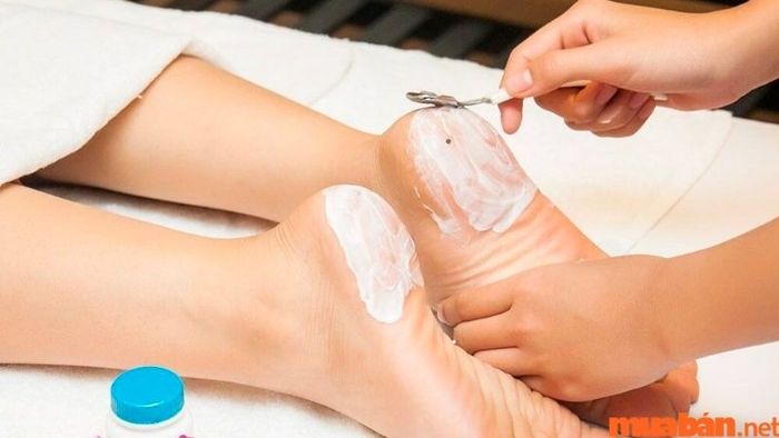 Liệu có nên tẩy nốt ruồi ở gót chân hay không?
