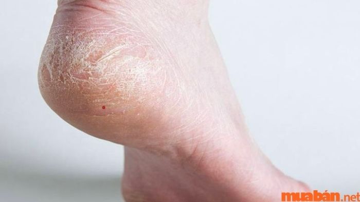 Nốt ruồi son ở gót chân nam là dấu hiệu của phúc tướng và vận mệnh tốt đẹp.