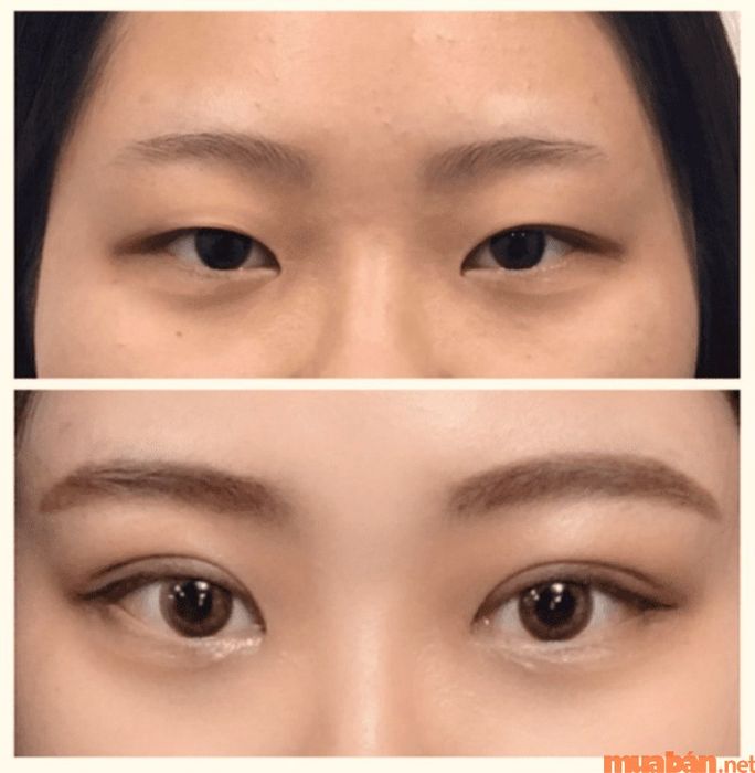 Một lựa chọn khác để làm đẹp cho đôi mắt của bạn là thẩm mỹ mắt.