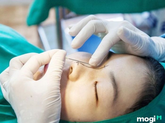 Phẫu thuật thay đổi hình dáng mũi két