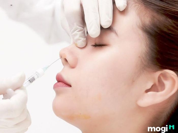 Tiêm filler để cải thiện dáng mũi két