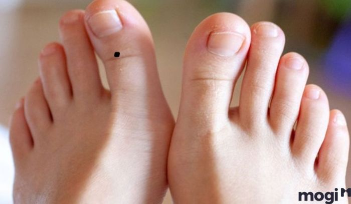 Nốt ruồi ở ngón cái chân