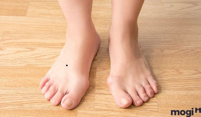 Nốt ruồi ở mu bàn chân là điềm báo không tốt