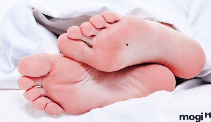 Nốt ruồi ở lòng bàn chân