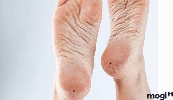 Liệu việc loại bỏ nốt ruồi có thật sự cần thiết?