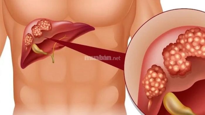 Hướng dẫn sử dụng cây xương khỉ trong các bài thuốc hỗ trợ điều trị viêm gan, xơ gan, vàng da